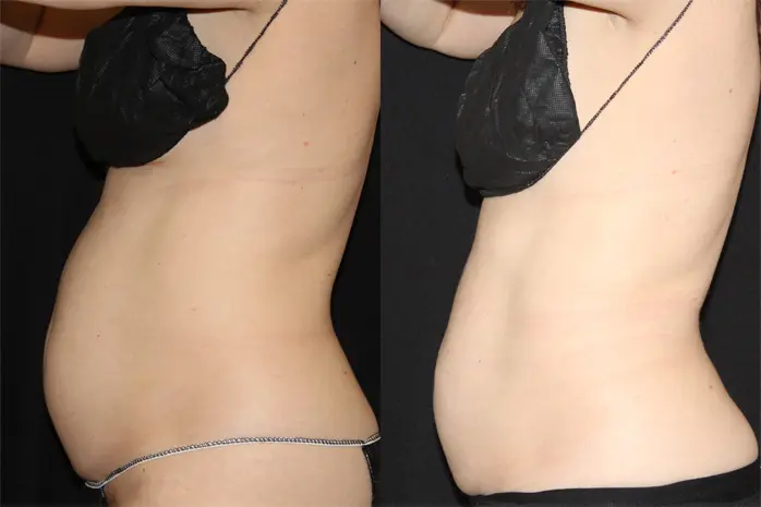 CoolSculptingยฎ Before and After Pictures Glastonbury, CT