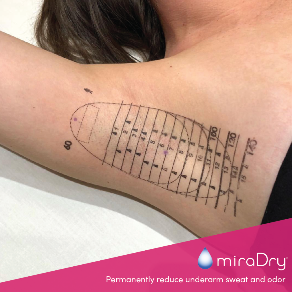 miraDry® in Glastonbury, CT