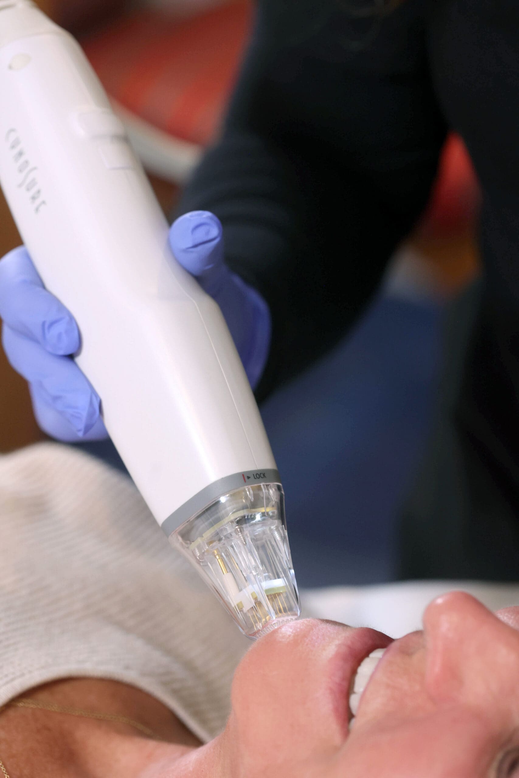 Microneedling Treatments in Glastonbury, CT