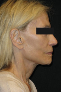 Laser-Ablative Before and After Pictures Glastonbury, CT