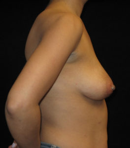 Breast Augmentation Before and After Pictures Glastonbury, CT