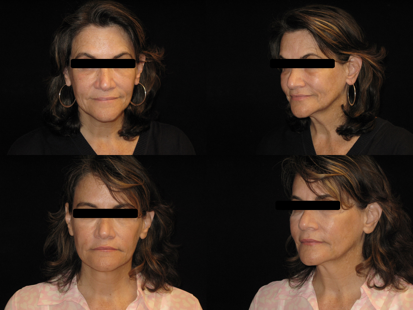 Juvederm Before and After Pictures Glastonbury, CT