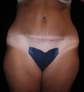 Abdominoplasty Before and After Pictures Glastonbury, CT
