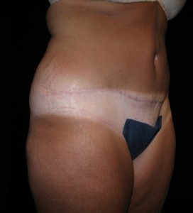 Abdominoplasty Before and After Pictures Glastonbury, CT