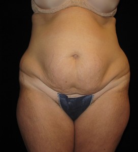 Abdominoplasty Before and After Pictures Glastonbury, CT