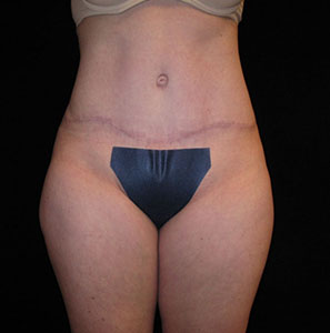 Tummy Tuck Before and After Pictures Glastonbury, CT