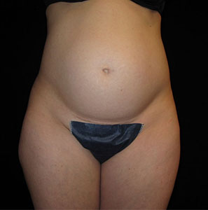 Tummy Tuck Before and After Pictures Glastonbury, CT