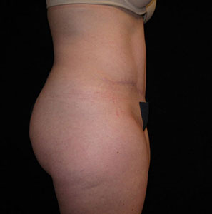 Tummy Tuck Before and After Pictures Glastonbury, CT