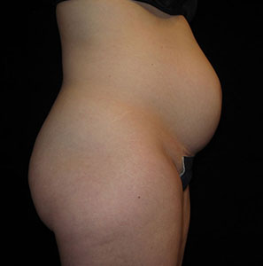 Tummy Tuck Before and After Pictures Glastonbury, CT