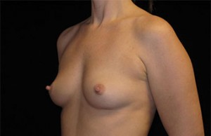Breast Augmentation Before and After Pictures Glastonbury, CT