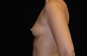 Breast Augmentation Before and After Pictures Glastonbury, CT