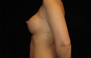 Breast Augmentation Before and After Pictures Glastonbury, CT