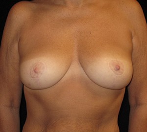 Breast Lift Before and After Pictures Glastonbury, CT