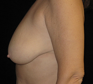Breast Lift Before and After Pictures Glastonbury, CT