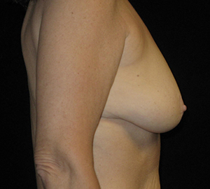 Breast Lift Before and After Pictures Glastonbury, CT