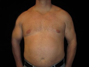 Gynecomastia Before and After Pictures Glastonbury, CT