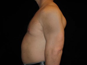 Gynecomastia Before and After Pictures Glastonbury, CT