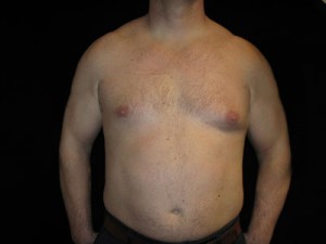 Gynecomastia Before and After Pictures Glastonbury, CT