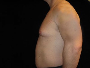 Gynecomastia Before and After Pictures Glastonbury, CT