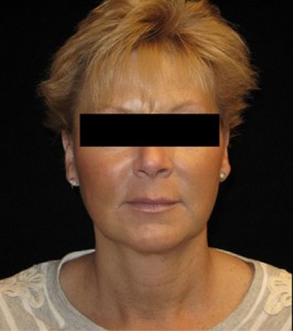 Facelift Before and After Pictures Glastonbury, CT