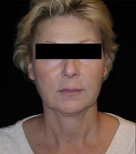 Facelift Before and After Pictures Glastonbury, CT