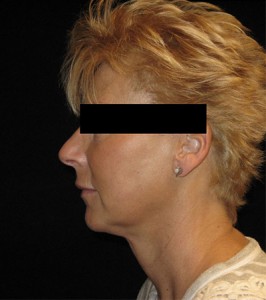 Facelift Before and After Pictures Glastonbury, CT