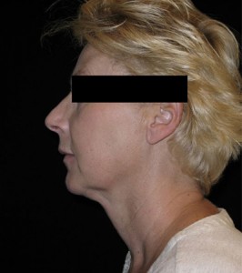 Facelift Before and After Pictures Glastonbury, CT