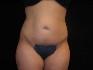 Liposuction Before and After Pictures Glastonbury, CT