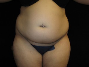Liposuction Before and After Pictures Glastonbury, CT