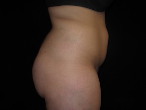 Liposuction Before and After Pictures Glastonbury, CT