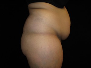 Liposuction Before and After Pictures Glastonbury, CT