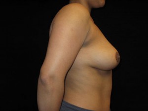 Breast Lift Before and After Pictures Glastonbury, CT