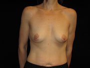 Breast Augmentation Before and After Pictures Glastonbury, CT