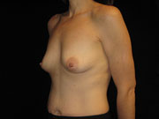 Breast Augmentation Before and After Pictures Glastonbury, CT