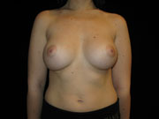 Breast Augmentation Before and After Pictures Glastonbury, CT