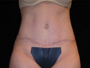 Abdominoplasty Before and After Pictures Glastonbury, CT