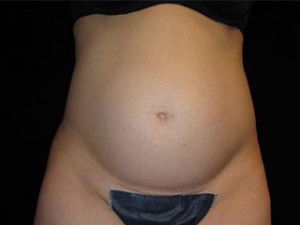 Abdominoplasty Before and After Pictures Glastonbury, CT