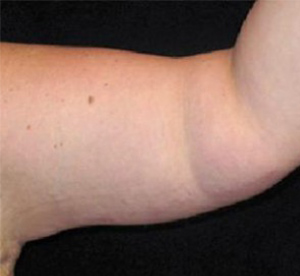 Arm Lift Before and After Pictures in Glastonbury, CT