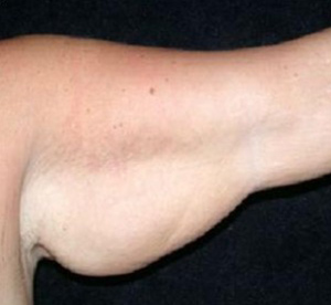 Arm Lift Before and After Pictures in Glastonbury, CT