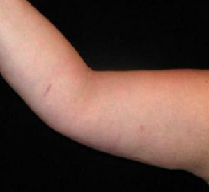 Arm Lift Before and After Pictures in Glastonbury, CT