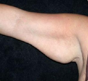 Arm Lift Before and After Pictures in Glastonbury, CT