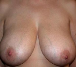 Breast Reduction Before and After Pictures Glastonbury, CT