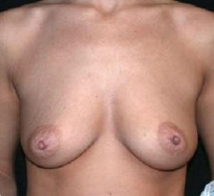 Breast Lift Before and After Pictures Glastonbury, CT