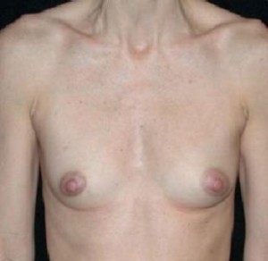 Breast Augmentation Before and After Pictures Glastonbury, CT