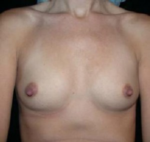 Breast Augmentation Before and After Pictures Glastonbury, CT