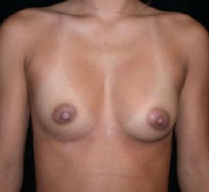 Breast Augmentation Before and After Pictures Glastonbury, CT