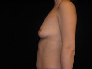 Breast Augmentation Before and After Pictures Glastonbury, CT