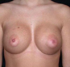 Breast Augmentation Before and After Pictures Glastonbury, CT