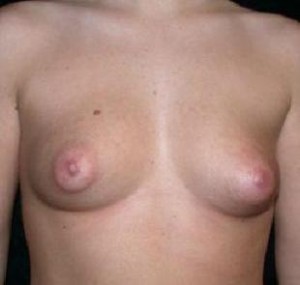 Breast Augmentation Before and After Pictures Glastonbury, CT