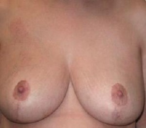 Breast Reduction Before and After Pictures Glastonbury, CT